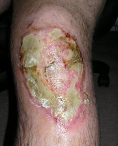 Pizza knee caused by concrete burns