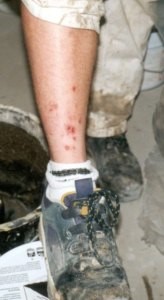 Allergic Dermatitis on Leg Possibly Caused by Concrete Contact